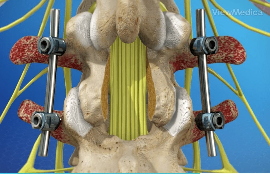 Spinal Fusion Photo