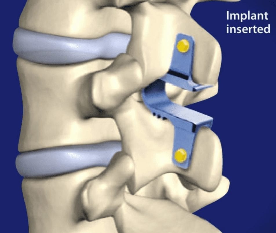 Coflex surgery