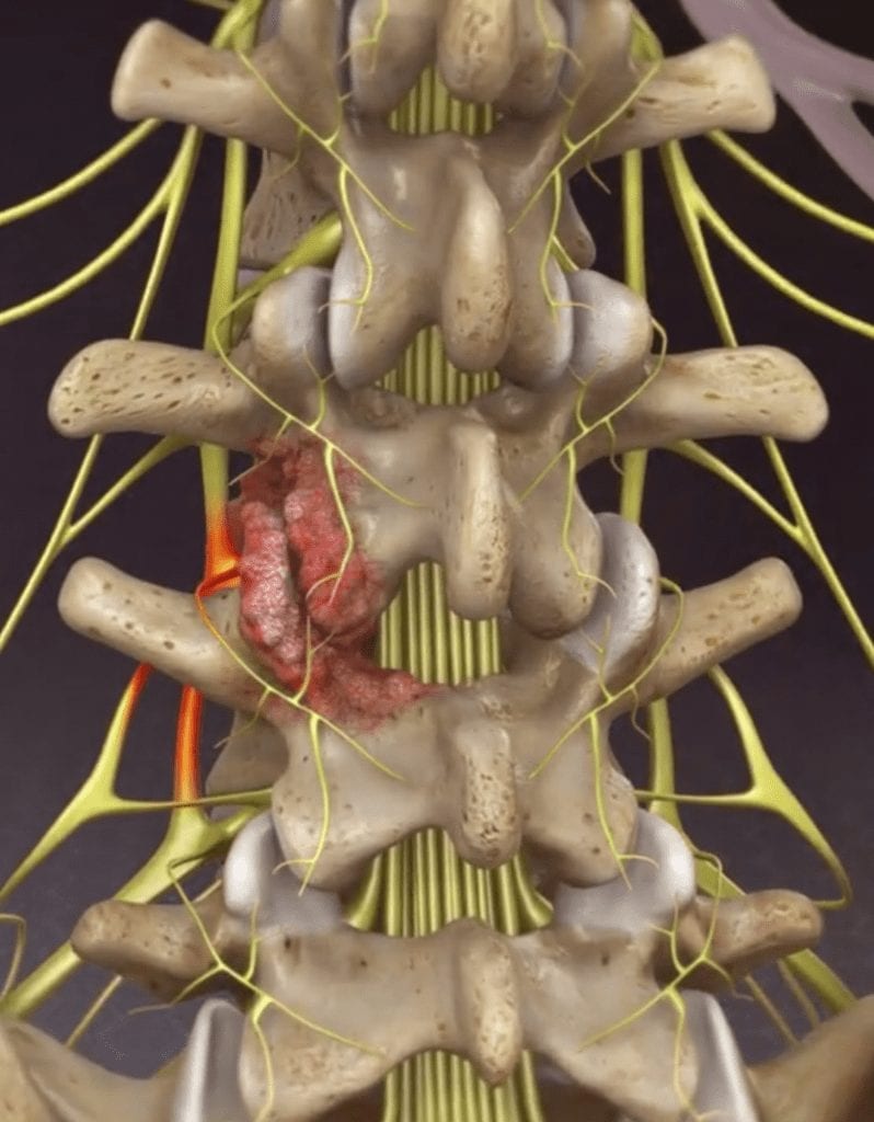 Foramintomy