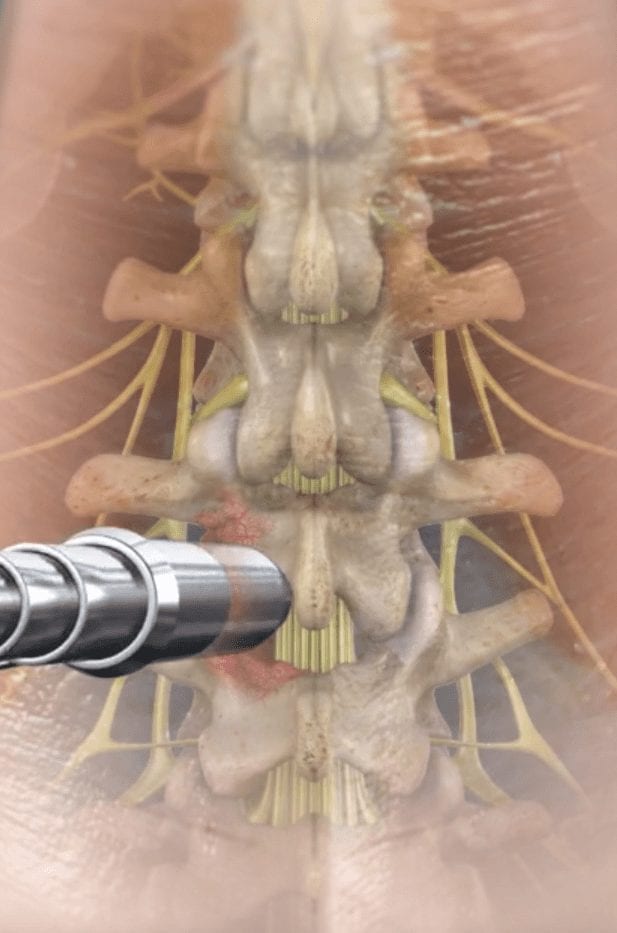Foramintomy Surgery