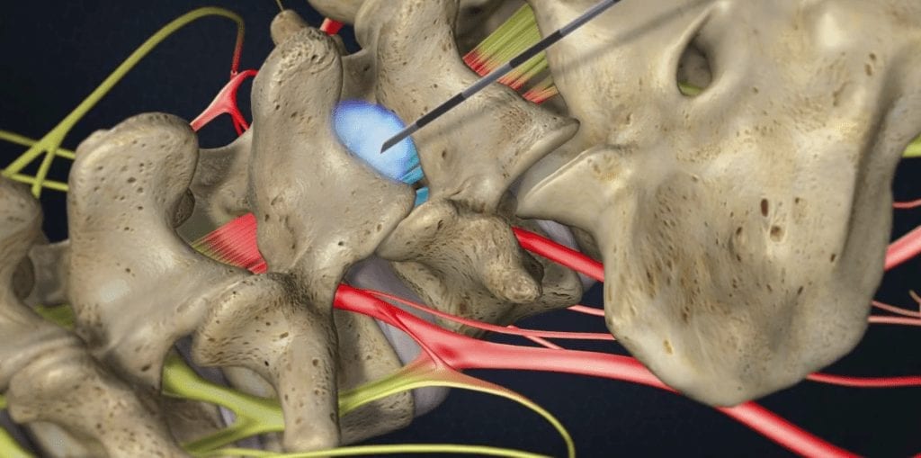 Lumbar Epidural Injection
