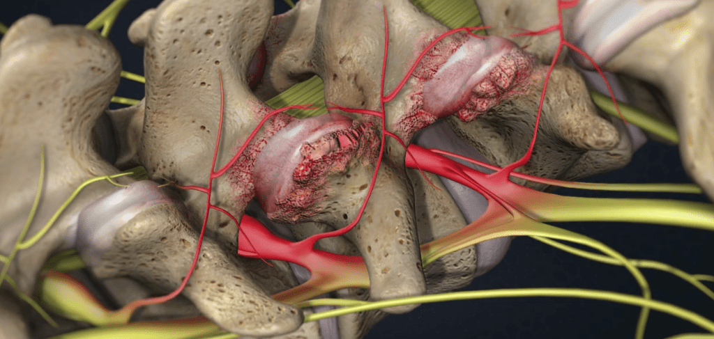 Facet Joint Pain