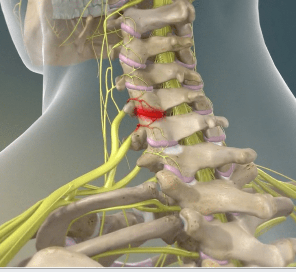 Radiofrequency Ablation