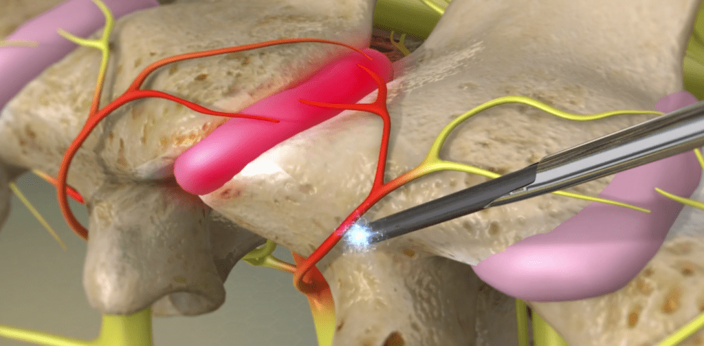 Radiofrequency Ablation Surgery