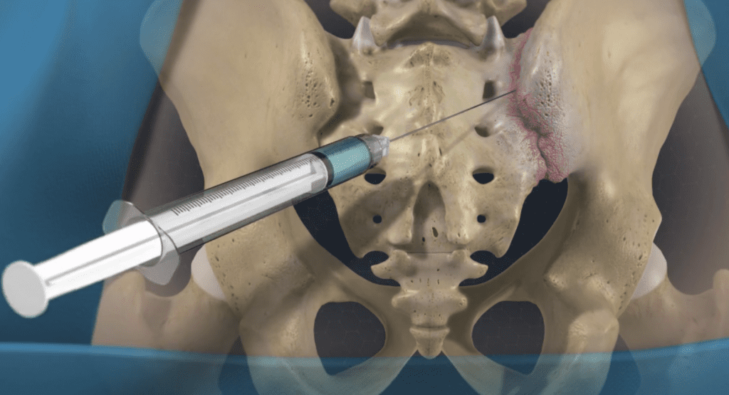 SI Joint Injection