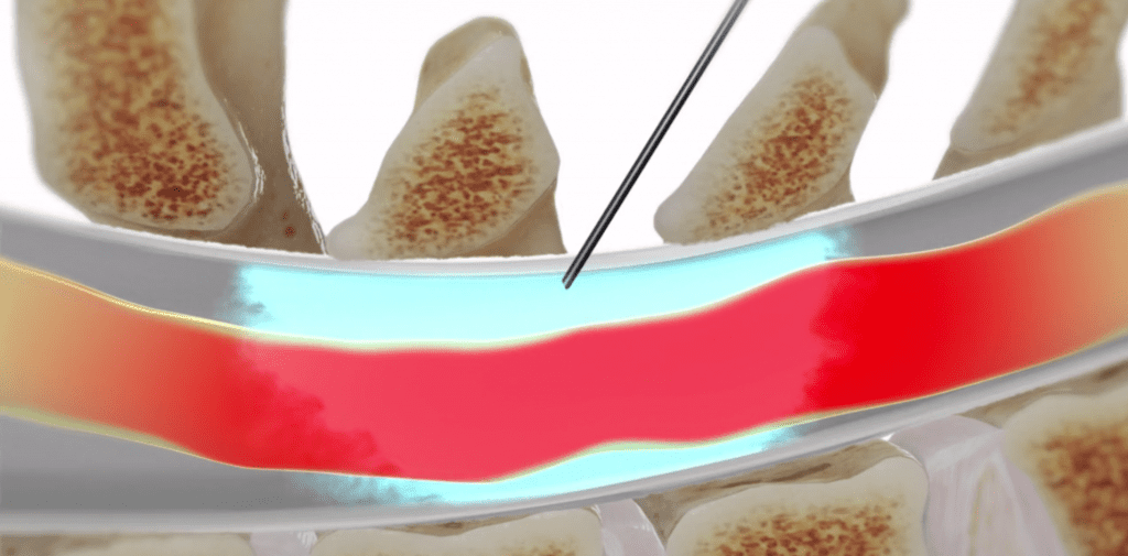 Epidural Steroid Injection in Neck