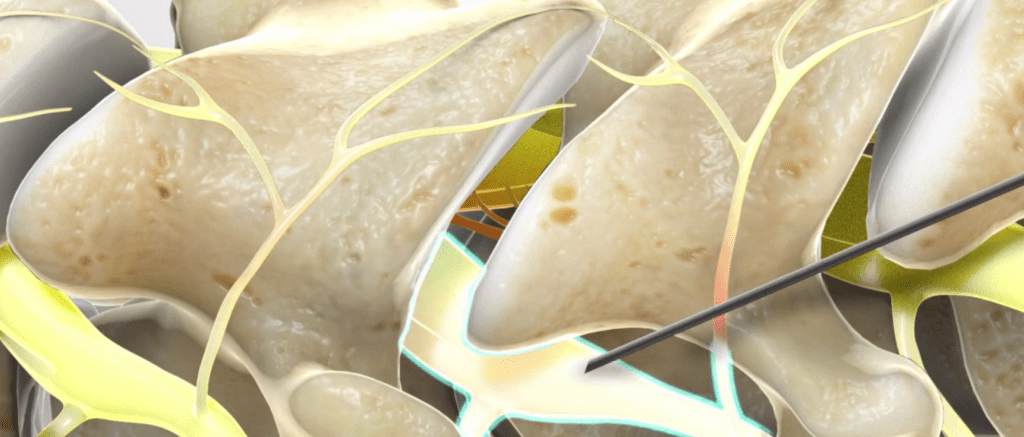 Selective Nerve Root Block