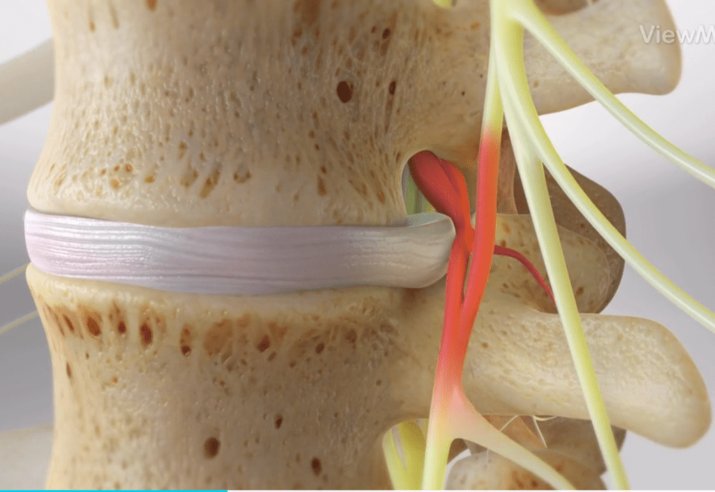 Disc Extrusion