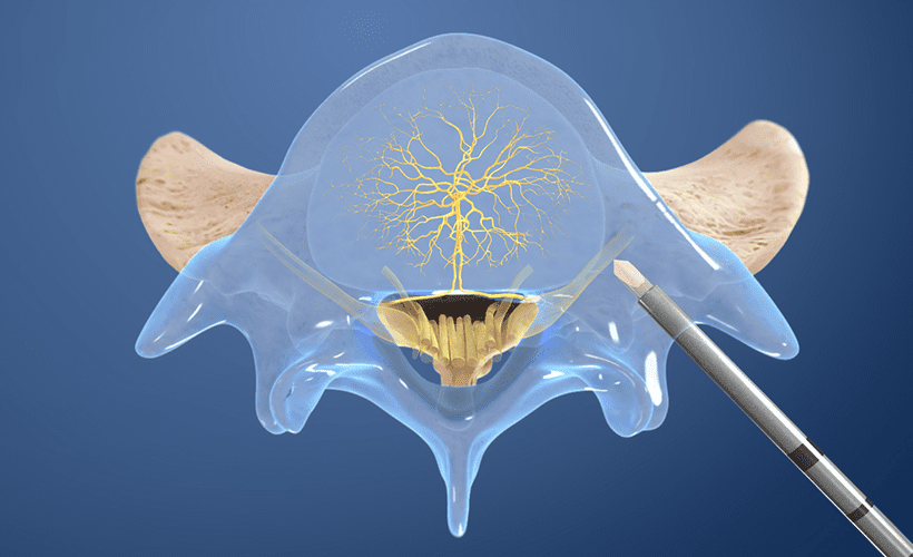 The Intracept Procedure