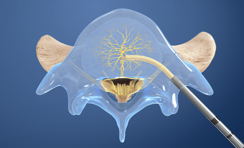 The Intracept Procedure