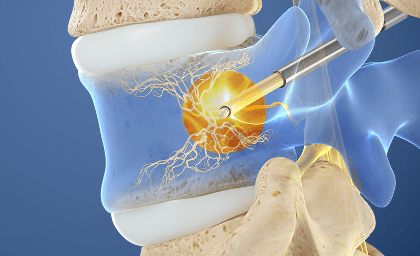 The Intracept Procedure