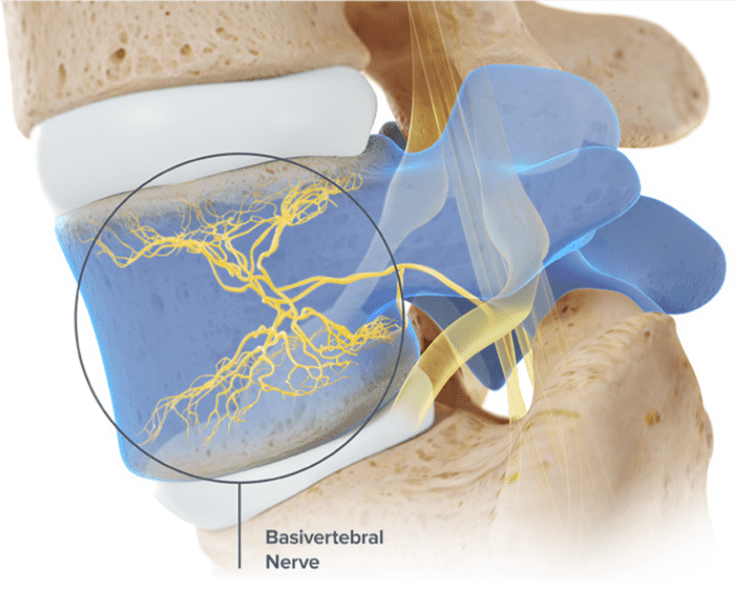 Image shows Basivertebral Nerve in spine