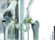 Orthopedic Interventions: Florida Specialists Offer Advanced Care
