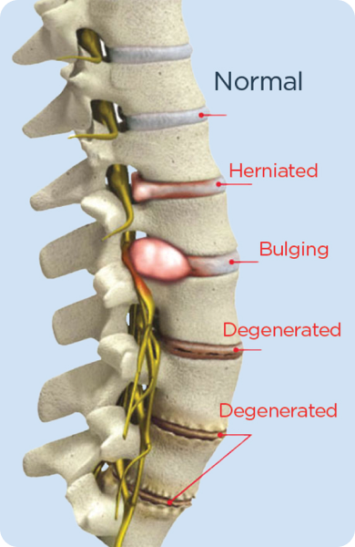 disc-disease-img