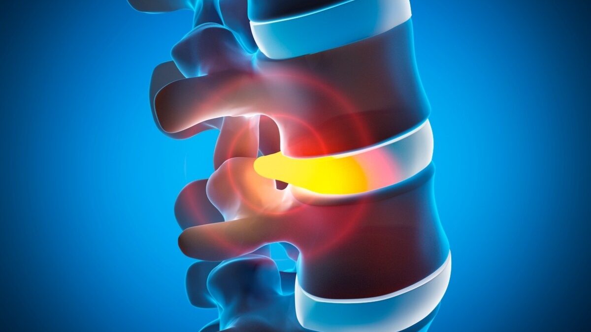 Understanding Herniated Discs: Symptoms, Conservative Care, and When Surgery Is Needed Understanding Herniated Discs: Symptoms, Conservative Care, and When Surgery Is Needed