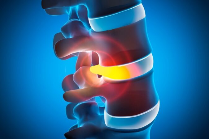 Understanding Herniated Discs: Symptoms, Conservative Care, and When Surgery Is Needed Understanding Herniated Discs: Symptoms, Conservative Care, and When Surgery Is Needed